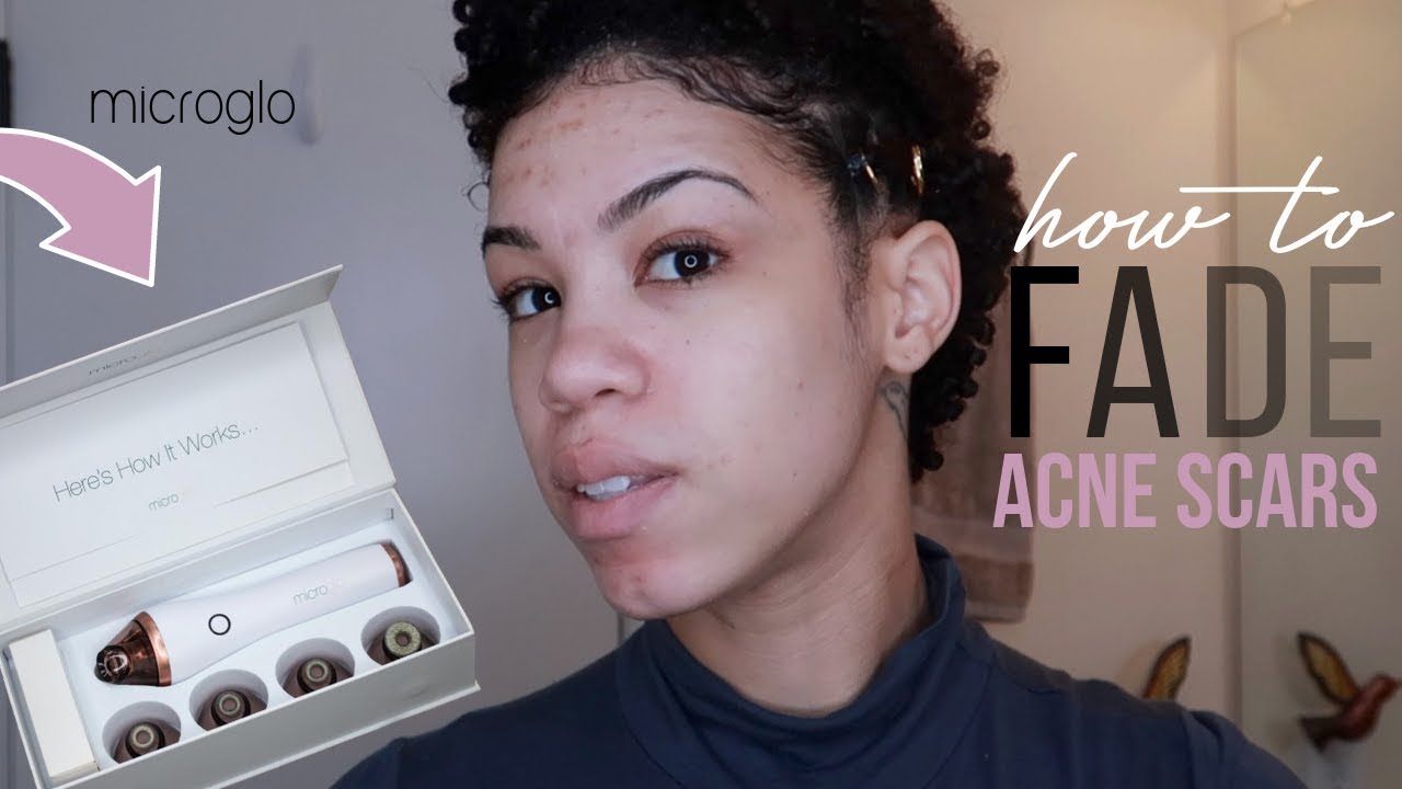 Microdermabrasion At Home Before and After