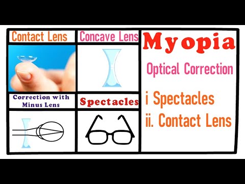 hogyan lehet visszaszerezni a leeső látást gimnasztika súlyos myopia esetén