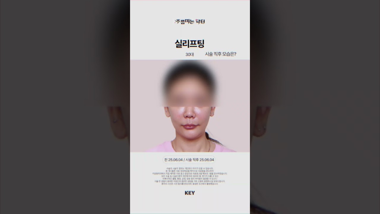 30대 실리프팅 직후모습