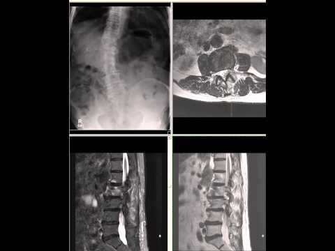Lumbar Spine - Typical MRI Interpretation