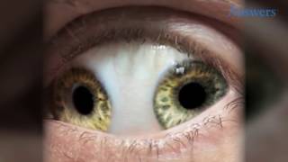 Rare Eye Conditions You Have To See To Believe