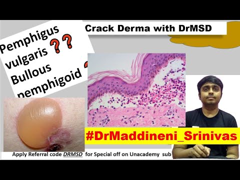 Pemphigus Vulgaris | BULLOUS PEMPHIGOID | Dermatitis herpetiformis Acantholysis Nikolsky sign #DrMSD