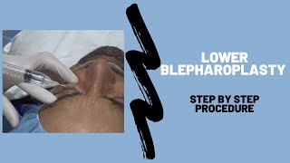 Lower Blepharoplasty - Step by Step Procedure Breakdown