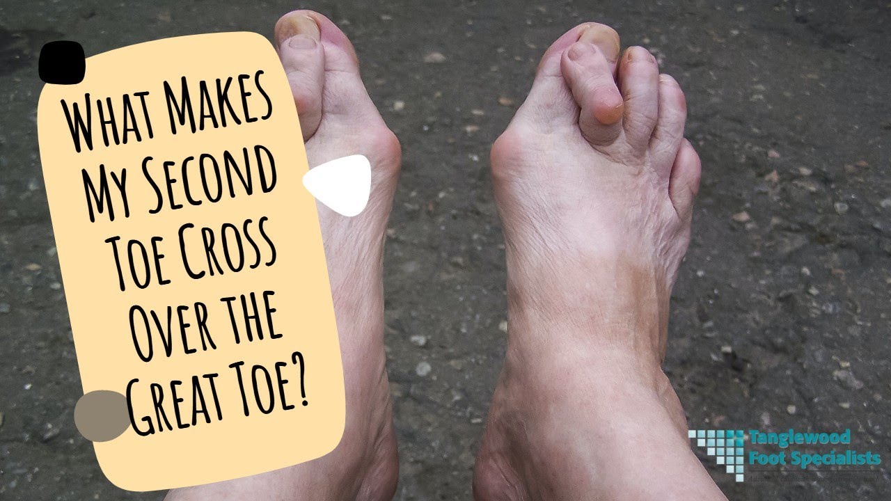 What Makes My Second Toe Cross Over the Great Toe?