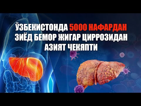 Ўзбекистонда 5000 нафардан зиёд бемор жигар циррозидан азият чекяпти