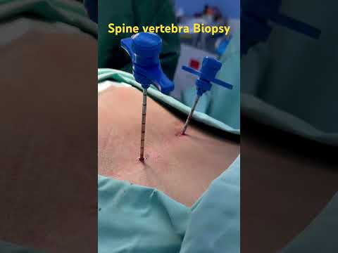 Bone Marrow Aspiration: How It’s Done | Dr. Ajay Kothari