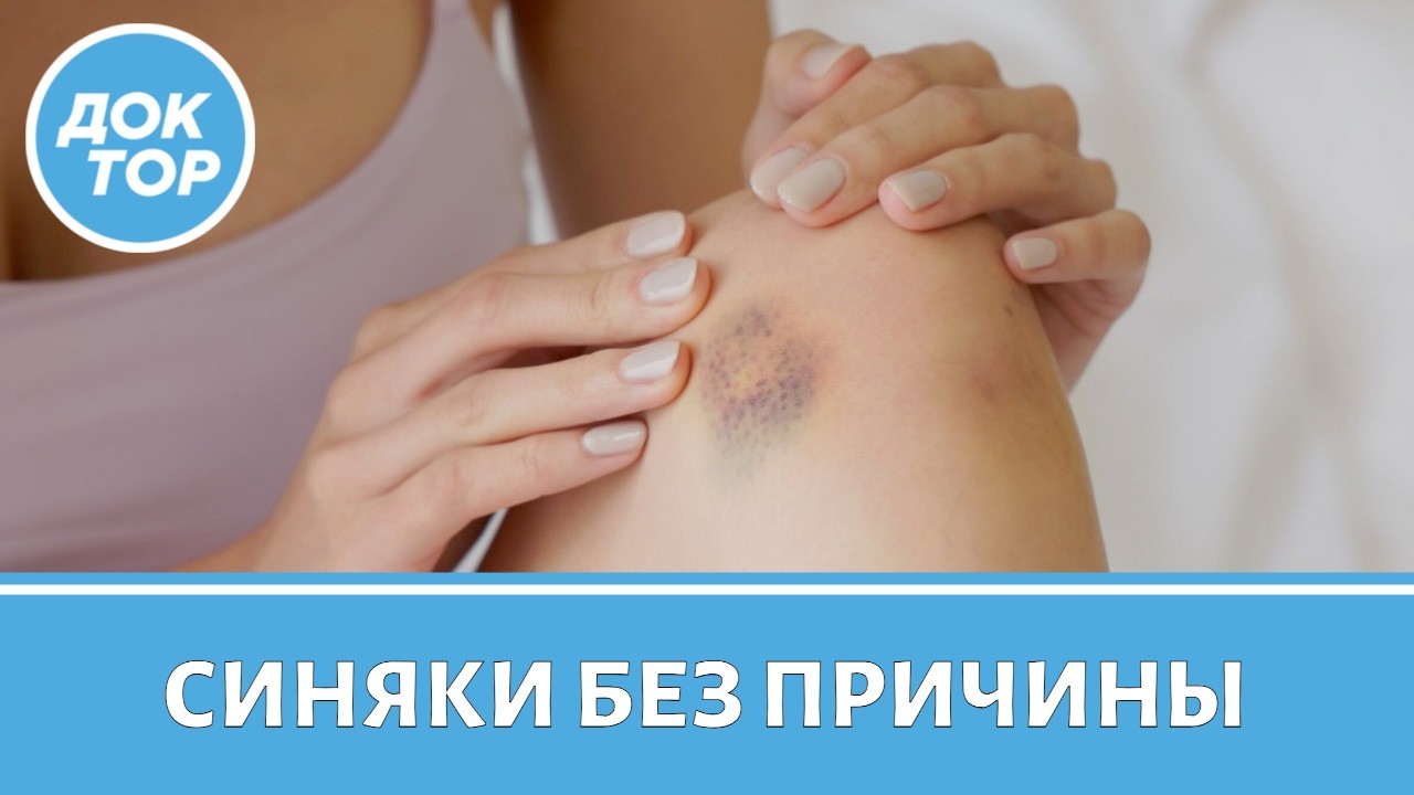 Синяки без причины: когда быть тревогу