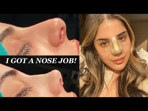 I GOT A NOSE JOB IN TURKEY WITH THE BEST SURGEON! - PART 1 | CLINICHUB