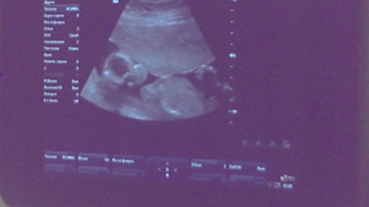 18 недель беременности. Определение пола. Мальчик.