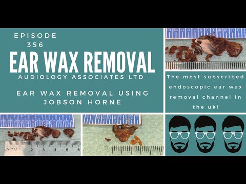 EAR WAX REMOVALS USING JOBSON HORNE - EP356