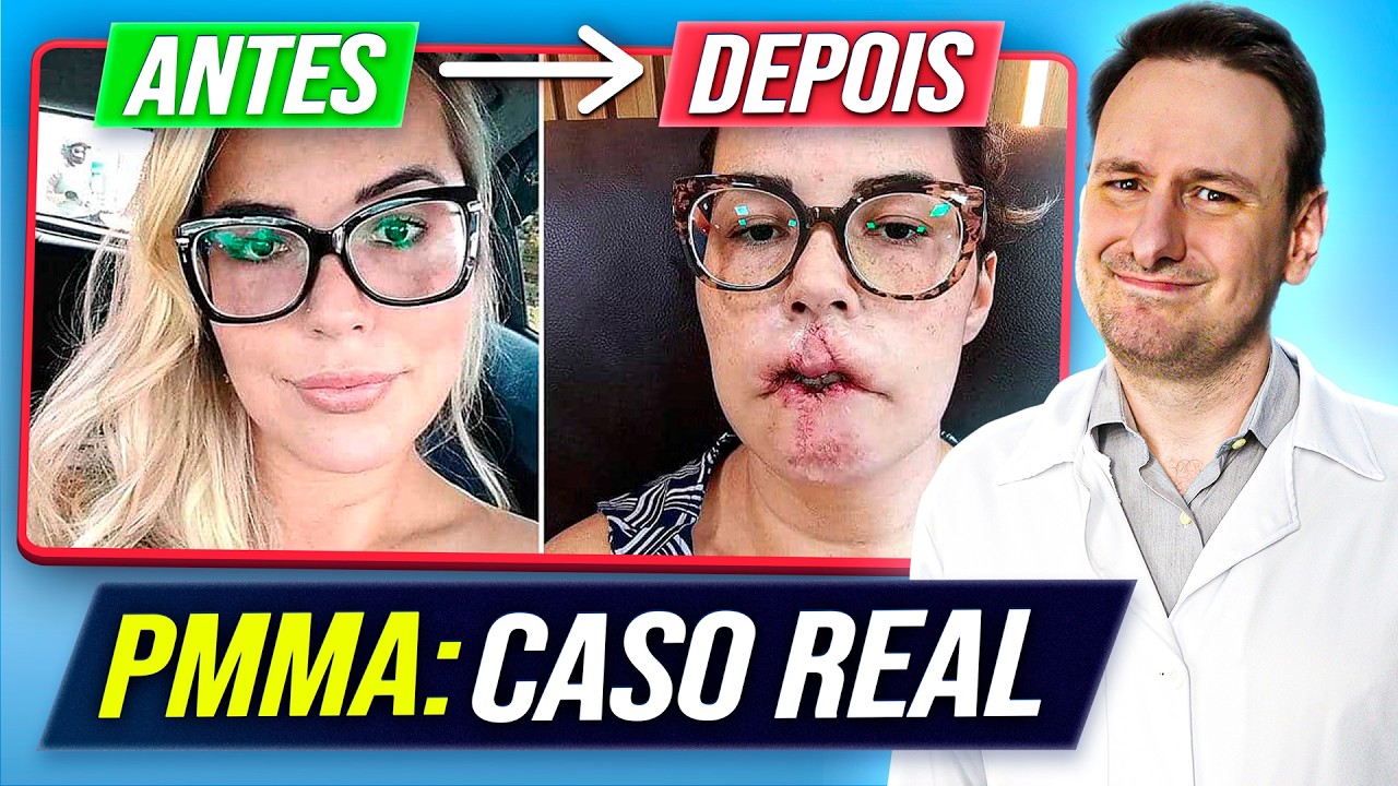 Os RISCOS do PMMA que escondem de você | Casos reais chocante