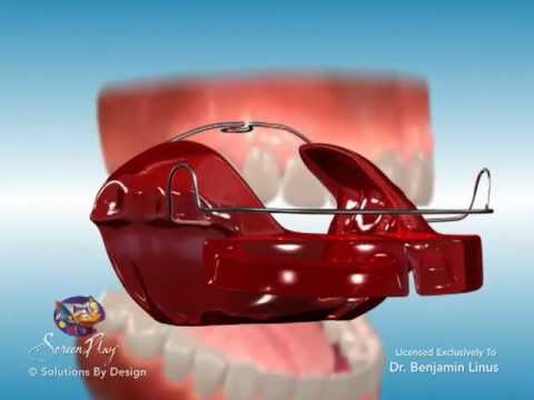 ScreenPlay Orthodontic Education Videos: Bionator Appliance
