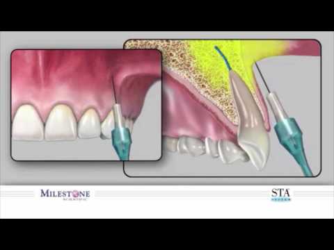 The Wand® STA Instrument - Supraperiosteal Buccal Infiltration