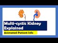Multi-cystic Dysplastic Kidneys explained... animated patient info