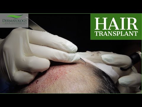 Hair Transplant from BEARD and CHEST - FULL Procedure...