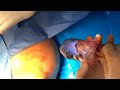 Rectal Foreign Body Removal - Kadlec Technique