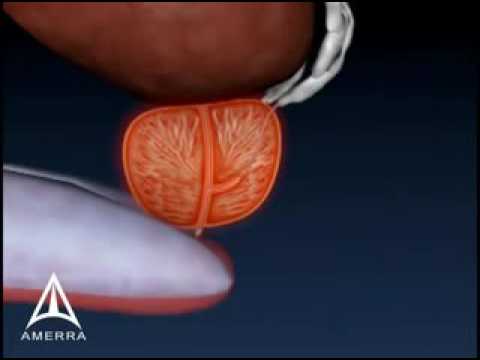 Tintura di Hemlock di prostatite Il grado di malattia prostatica