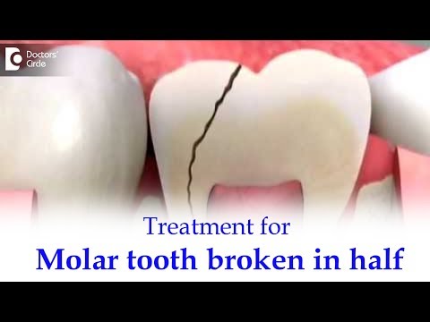 Back tooth/Molar tooth broke in half inside. What to do? - Dr. Ranjani Rao | Doctors' Circle