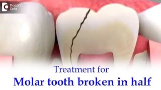 Back tooth/Molar tooth broke in half inside. What to do? - Dr. Ranjani Rao | Doctors