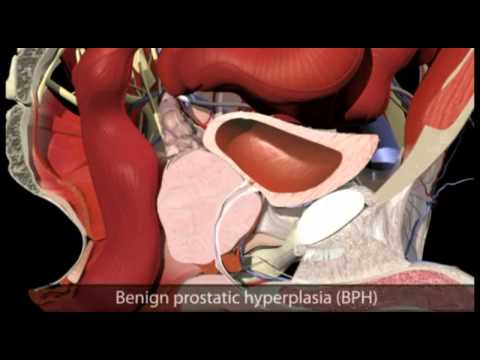 Benign Prostatic Hyperplasia