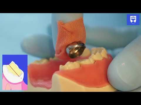 Stainless Steel Crown Technique for a Primary Molar Tooth