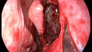 INCHIDERE ENDOSCOPICA FISTULA LCR LICHID CEFALO RAHIDIAN TAVAN ETMOIDAL Dr Bogdan MOCANU