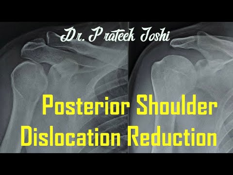 Posterior Shoulder Dislocation Reduction | Dr. Prateek Joshi