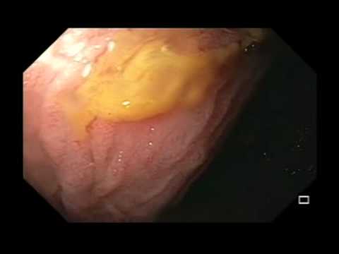 Small Bowel, Benign Findings, Massive Small Bowel Dilation from Motility Disorder.