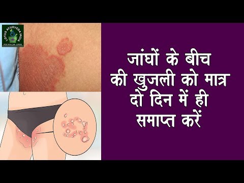 Bilang isang makulayan ng propolis sa paggamot ng kuko halamang-singaw Onychomycosis halamang-singaw sa daliri ng paa kuko paggamot