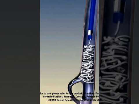 Varicocele embolization live case - Step 7 #nosurgery | Dr. Gaurav Gangwani