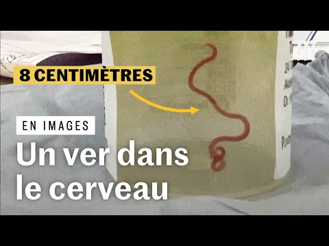Australie : un ver vivant retiré du cerveau d’une patiente