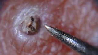 Itchy ingrown hair removed