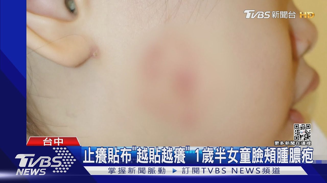 止癢貼布「越貼越癢」 1歲半女童臉頰腫膿疱