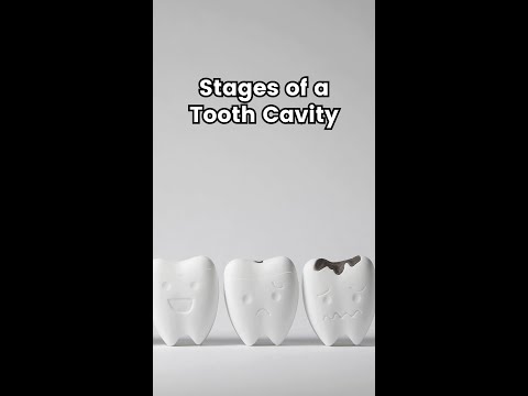 Stages of a Tooth Cavity