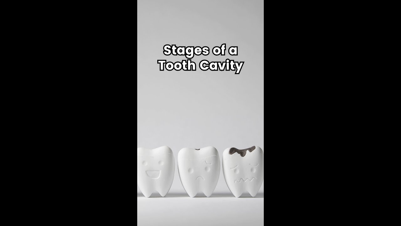 Stages of a Tooth Cavity