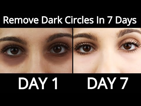 Top 5 Home Remedies To Remove Dark Circles Permanently In 7 Days - How To Remove Dark Circles Video