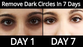 Top 5 Home Remedies To Remove Dark Circles Permanently In 7 Days - How To Remove Dark Circles