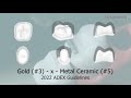 PASS THE CDCA 3 X 5 Fixed Partial Denture Preparation My Dental Key