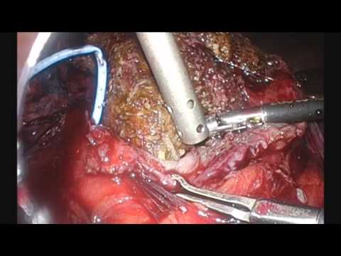 Laparoscopic Pyelolithotomy of Giant Staghorn Stone in a Horseshoe Kidney