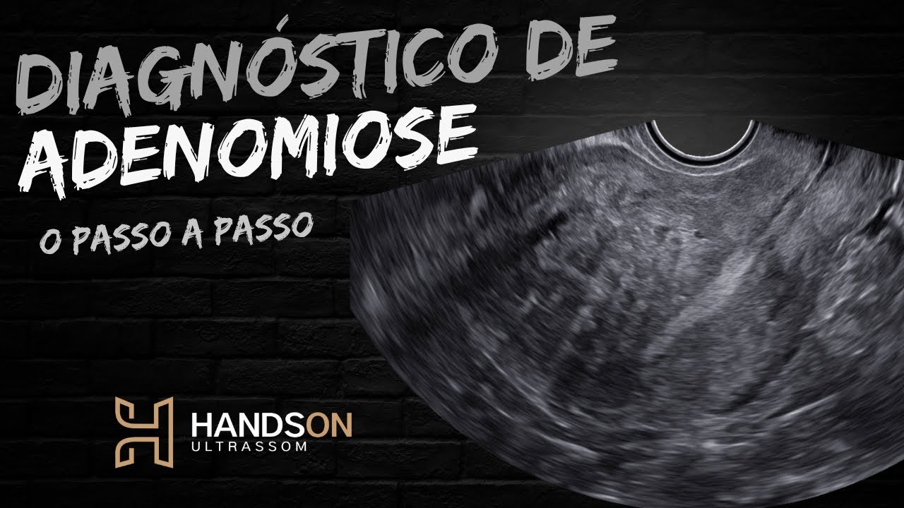 Aula: Adenomiose uterina: Consenso atual para diagnóstico ultrassonográfico