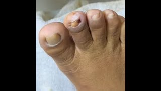 Ep_8300 Foot nails skin removal 👣 ไม่เจ็บ..แต่กลัวค่ะ 😄 (clip from Thailand)