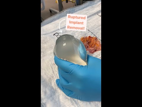 Best Seattle Gummy Bear Breast Implants