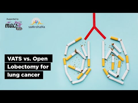VATS vs. Open Lobectomy for lung cancer | Episode 12