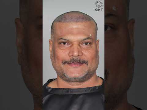 Daya Hair Transplant Surgery Result | Daya Before & After Hair Transplant #shorts #viral