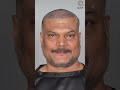 Daya Hair Transplant Surgery Result Daya Before After Hair Transplant Shorts Viral