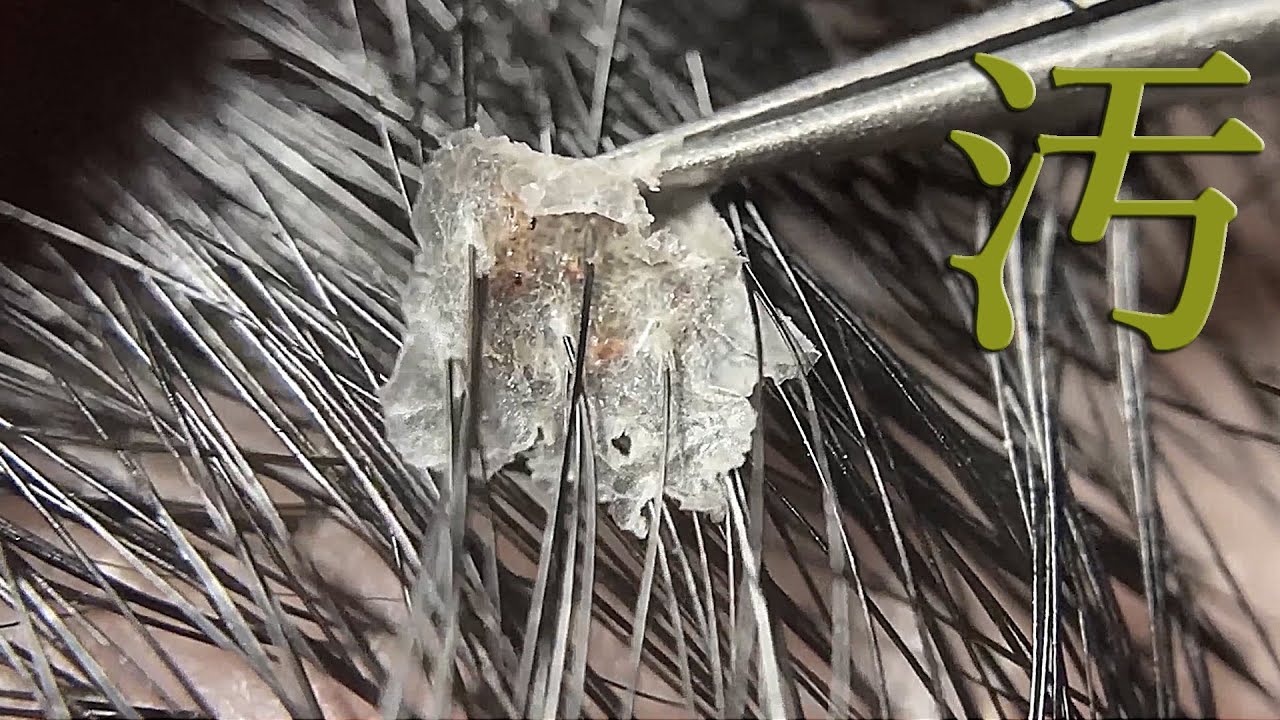 No.199 汚頭皮 / Removes dandruff from dirty scalp / Видаляє лупу з брудної шкіри голови / 去除髒頭皮上的頭皮屑