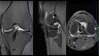 RM rotura en asa de cubo menisco interno.