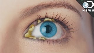 Why Do We Get Eye Boogers?