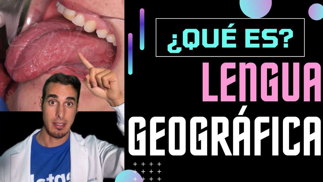 LENGUA GEOGRÁFICA o GLOSITIS MIGRATORIA - Causa y tratamiento #shorts