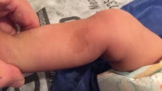 Mancha cafe con leche en la piel.